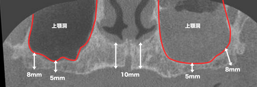 上顎の骨量が部分的に少ない方のレントゲン画像