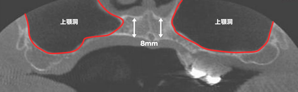 上顎の骨量が広範囲で少ない方のレントゲン画像