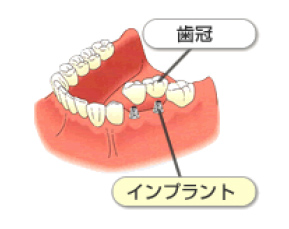 インプラント