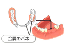 入れ歯