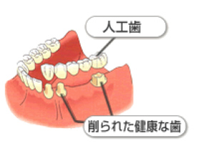 ブリッジ