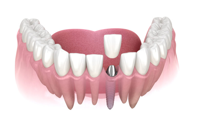 前歯のインプラントはデメリットが多い？注意点と対処法【歯科医師監修】